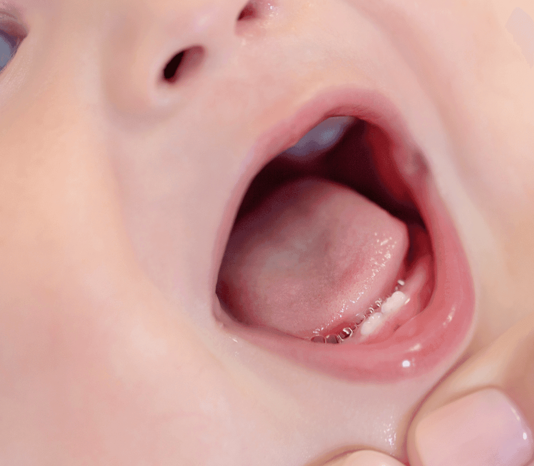 Gestionarea Eruptiilor Dentare la Bebeluși: Sfaturi Utile pentru Părinți