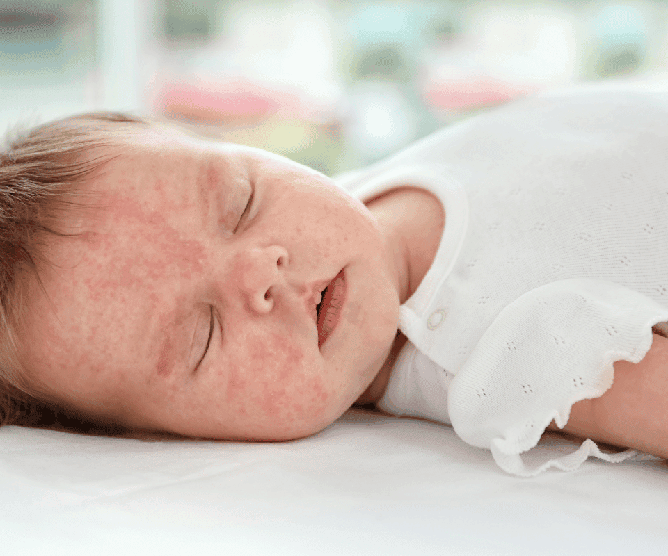 Înțelegerea Alergiilor la Lactate la Bebeluși: Cauze, Simptome, Tratament